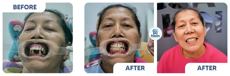 Hasil perawatan {{ result?.title }} Passion Dental Care