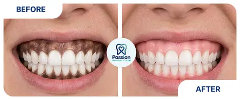 Hasil perawatan {{ result?.title }} Passion Dental Care