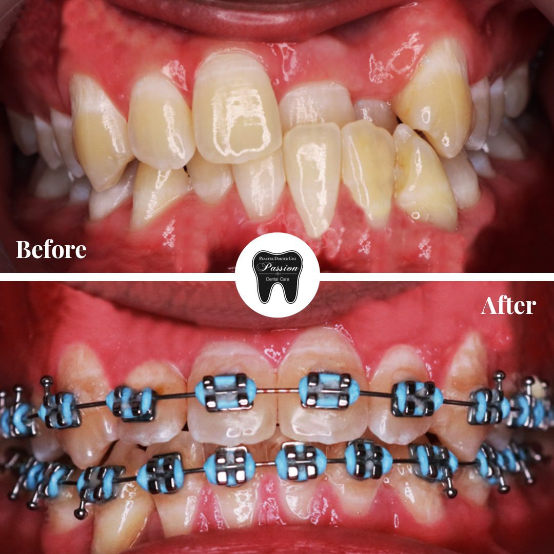 behel-gigi-before-after-1-min