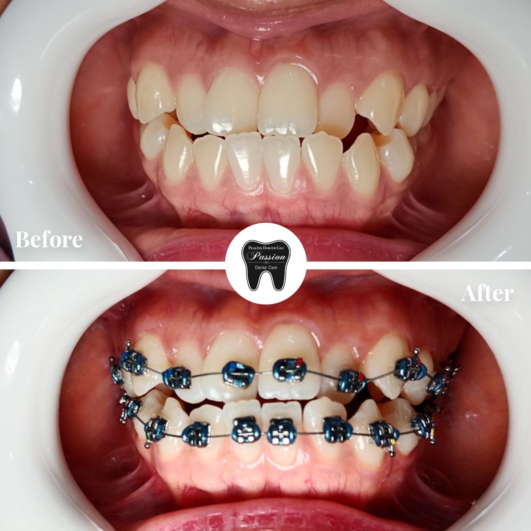 behel-gigi-before-after-4-min