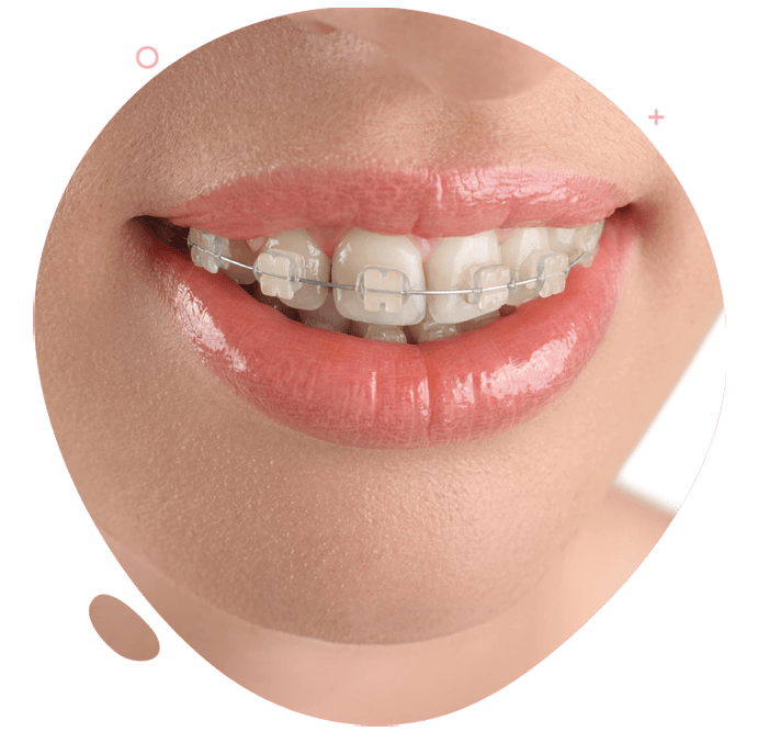 https://www.passiondentalcare.com/wp-content/uploads/2022/12/bracket-ceramic-images-min.png