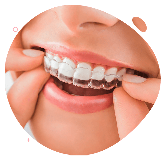 https://www.passiondentalcare.com/wp-content/uploads/2022/12/bracket-klar-clear-aligner-images-min.png