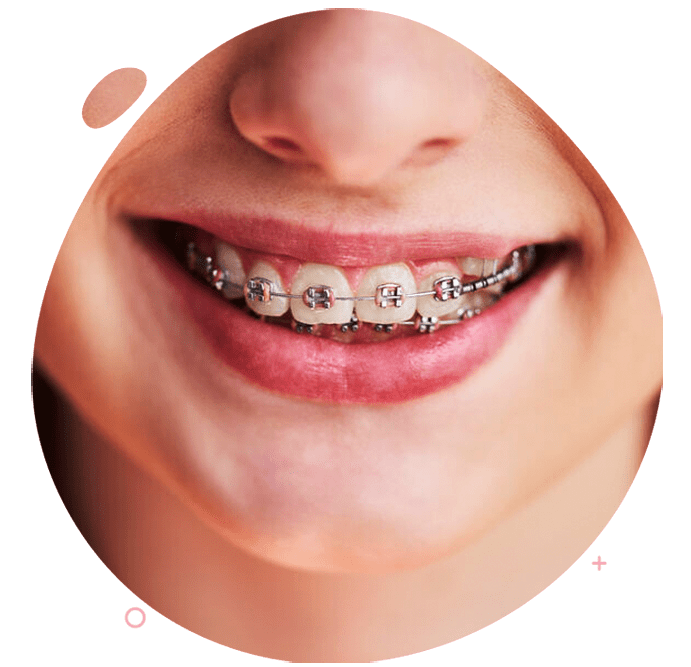 https://www.passiondentalcare.com/wp-content/uploads/2022/12/bracket-metal-images-min.png