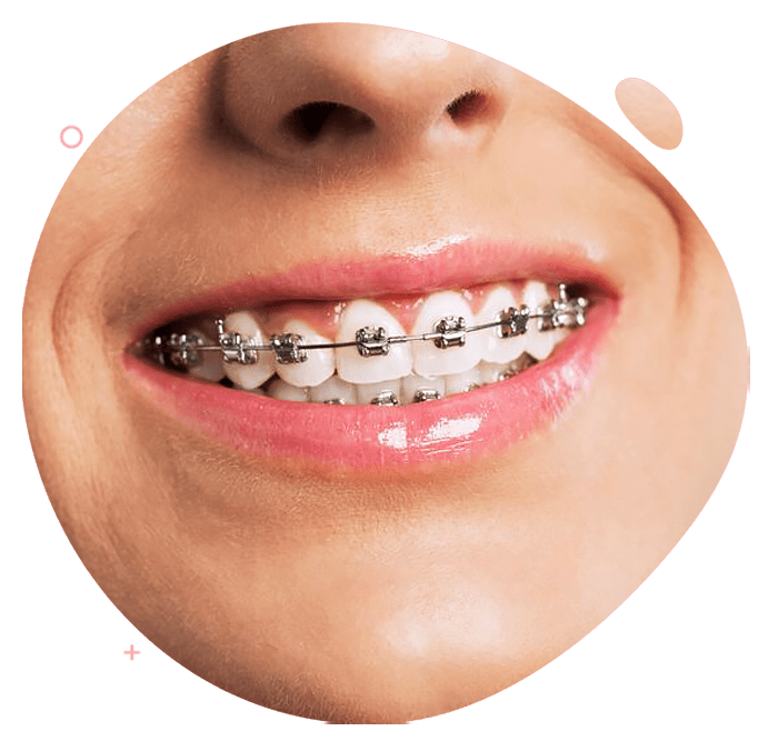 https://www.passiondentalcare.com/wp-content/uploads/2022/12/bracket-self-ligating-images-pdc.png