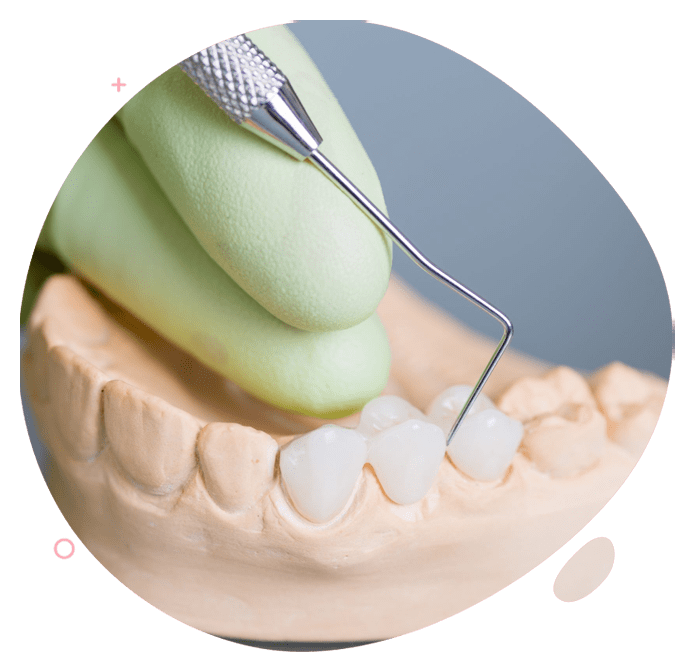 https://www.passiondentalcare.com/wp-content/uploads/2022/12/crown-bridge-full-porcelain-images-min.png