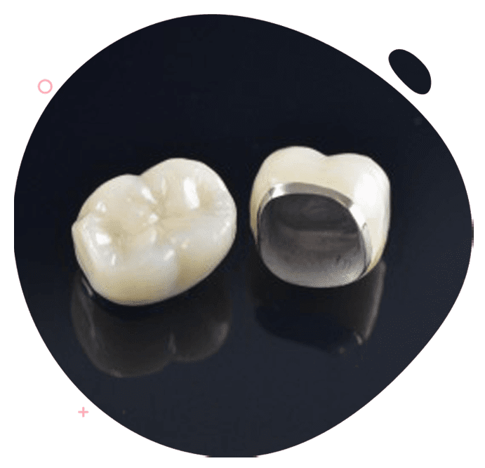 https://www.passiondentalcare.com/wp-content/uploads/2022/12/crown-bridge-metal-porcelain-images-min.png