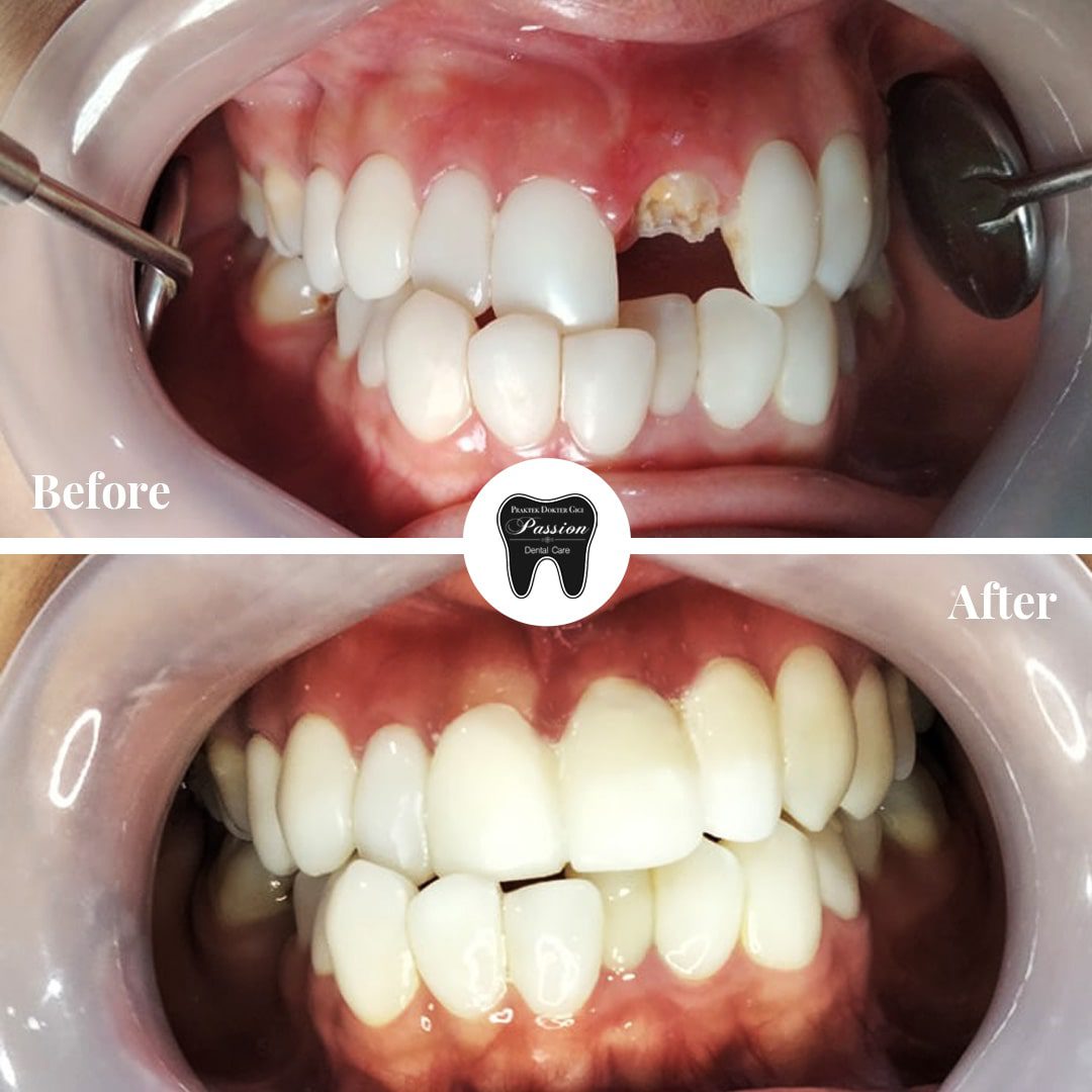 gigi-palsu-permanen-before-after-1-min