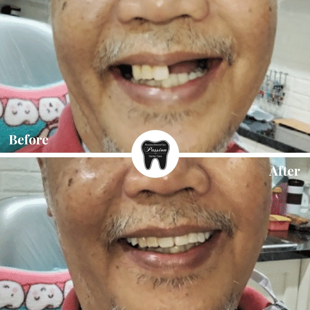 gigi-palsu-permanen-before-after-3-min