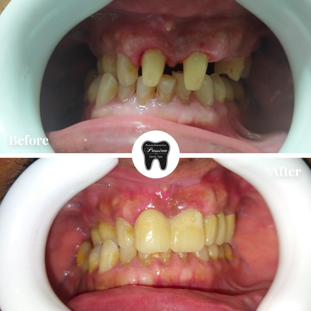 gigi-palsu-permanen-before-after-5-min