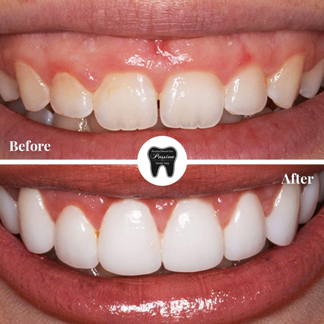 gum-lifting-before-after-1-min