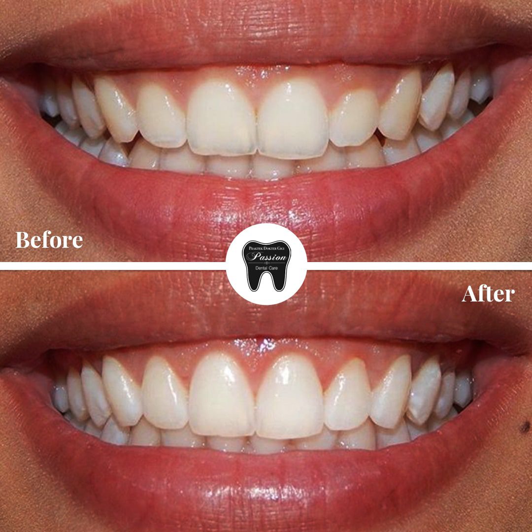 gum-lifting-before-after-2-min