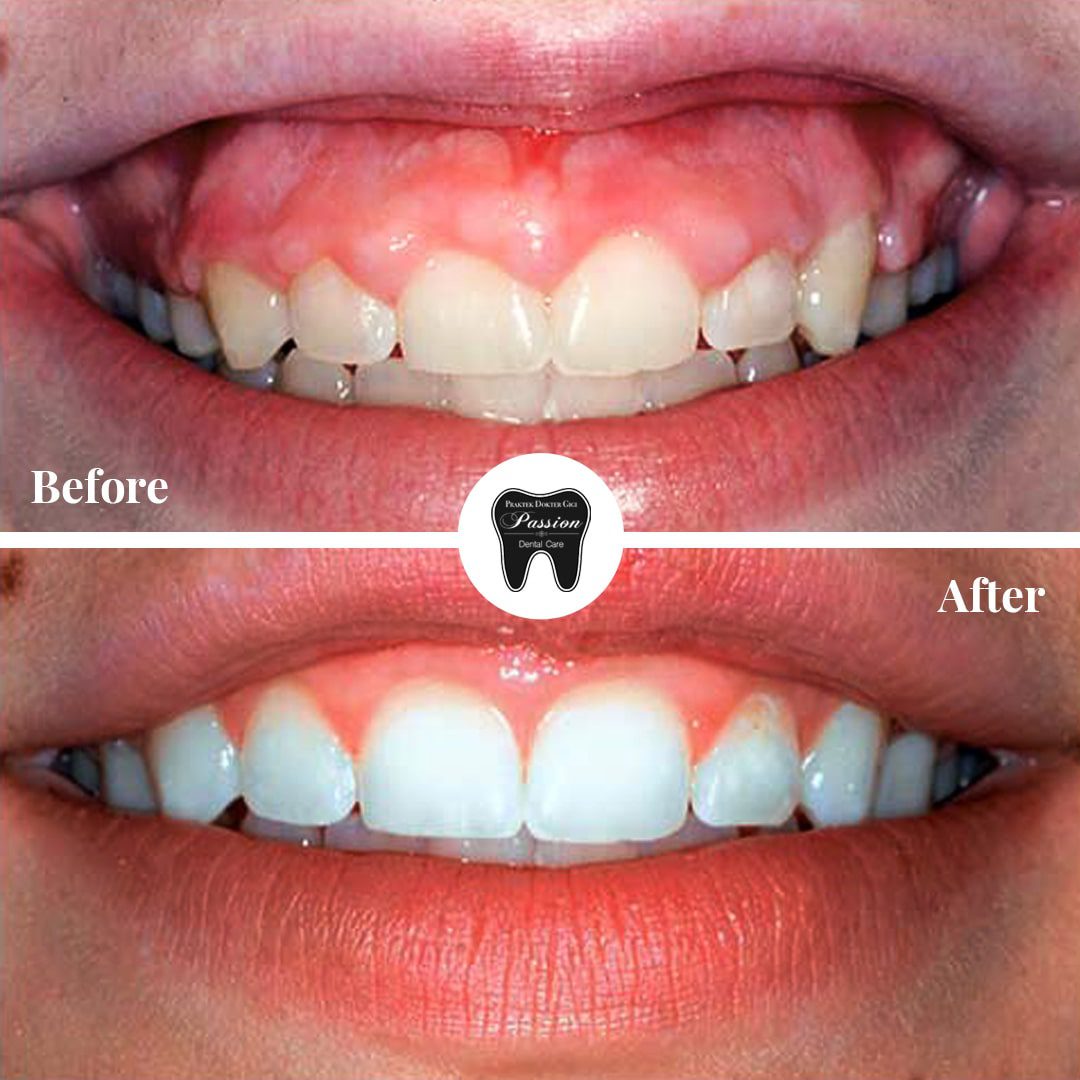 gum-lifting-before-after-3-min