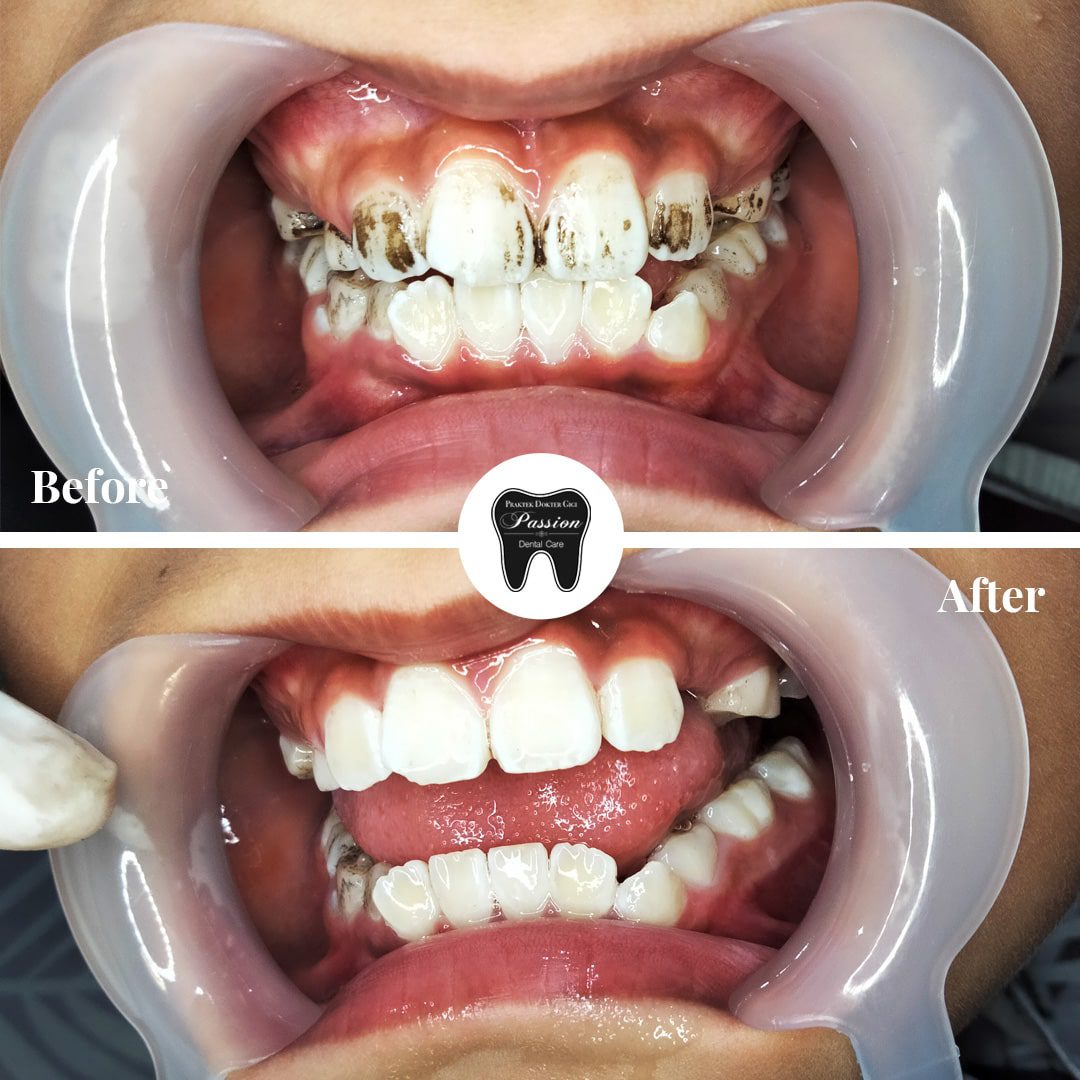 scaling-gigi-before-after-1-min