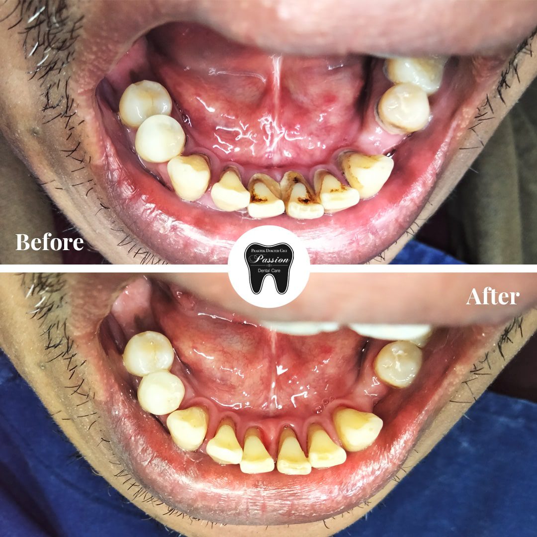 scaling-gigi-before-after-2-min