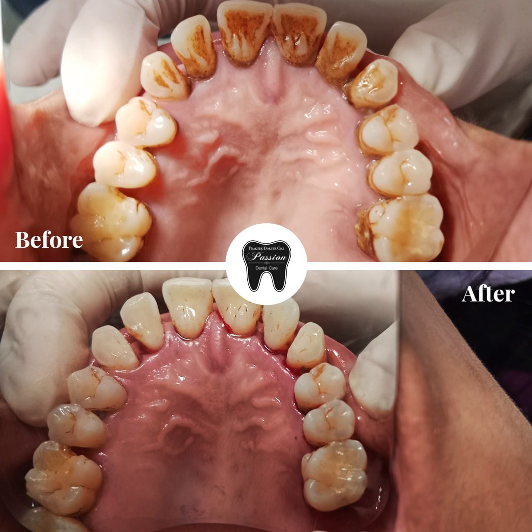 scaling-gigi-before-after-3-min