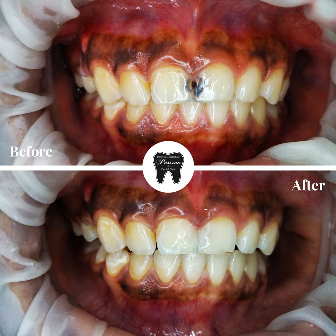 tambalan-estetis-before-after-1-min