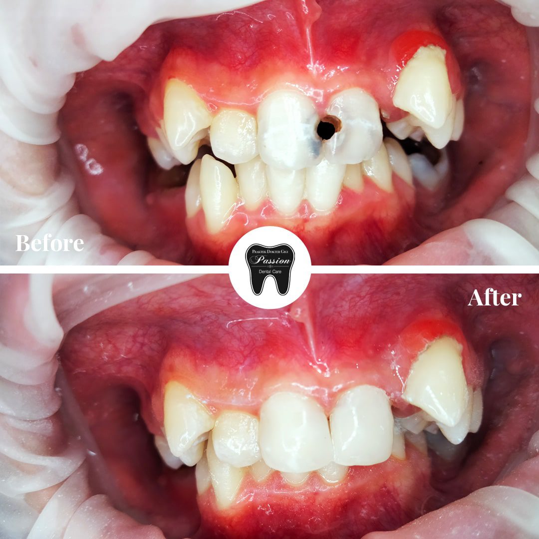 tambalan-estetis-before-after-2-min