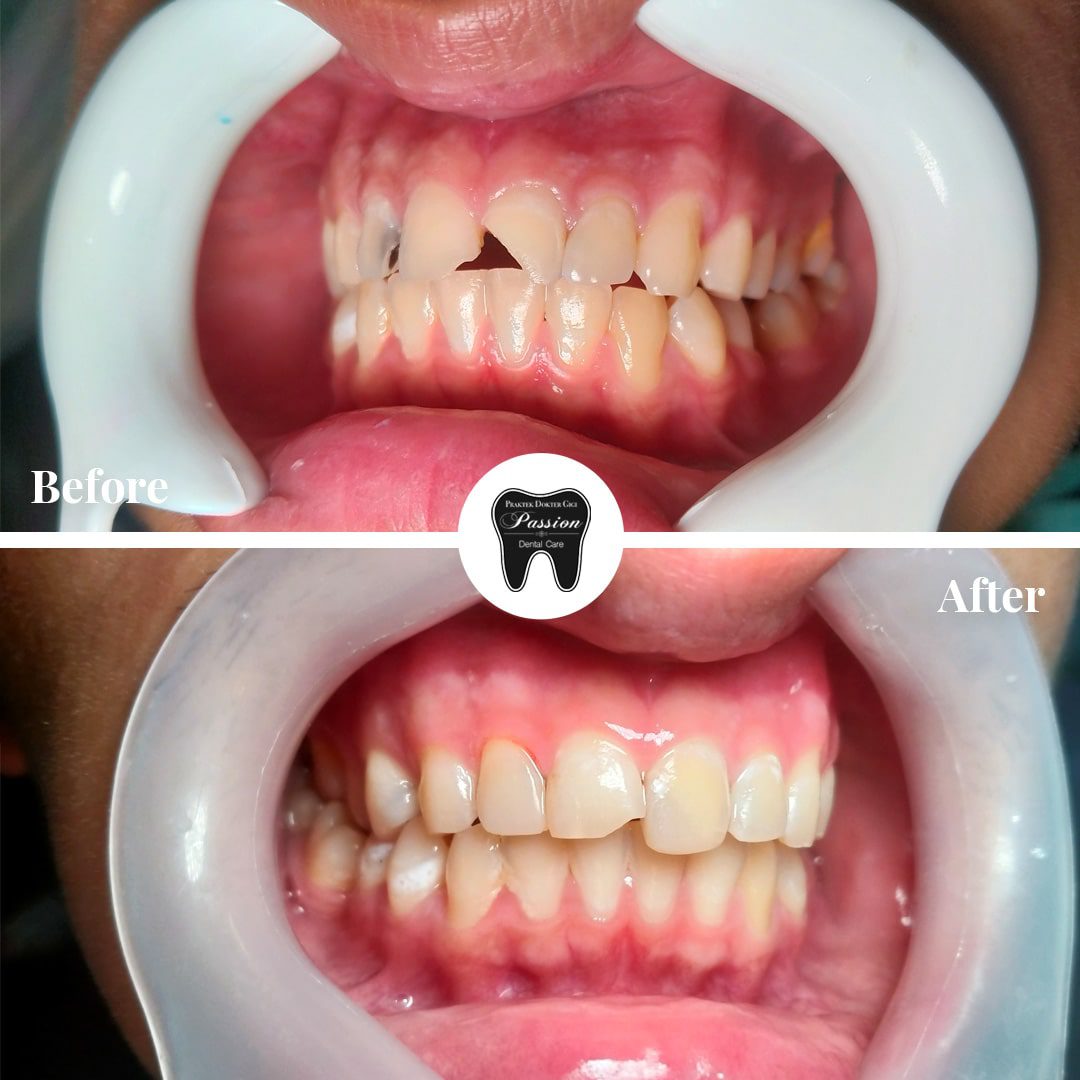 tambalan-estetis-before-after-3-min