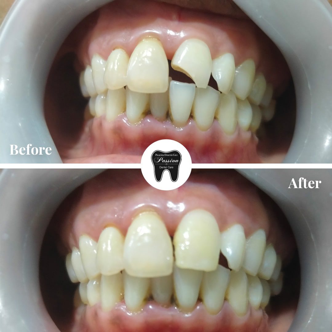 tambalan-estetis-before-after-4-min