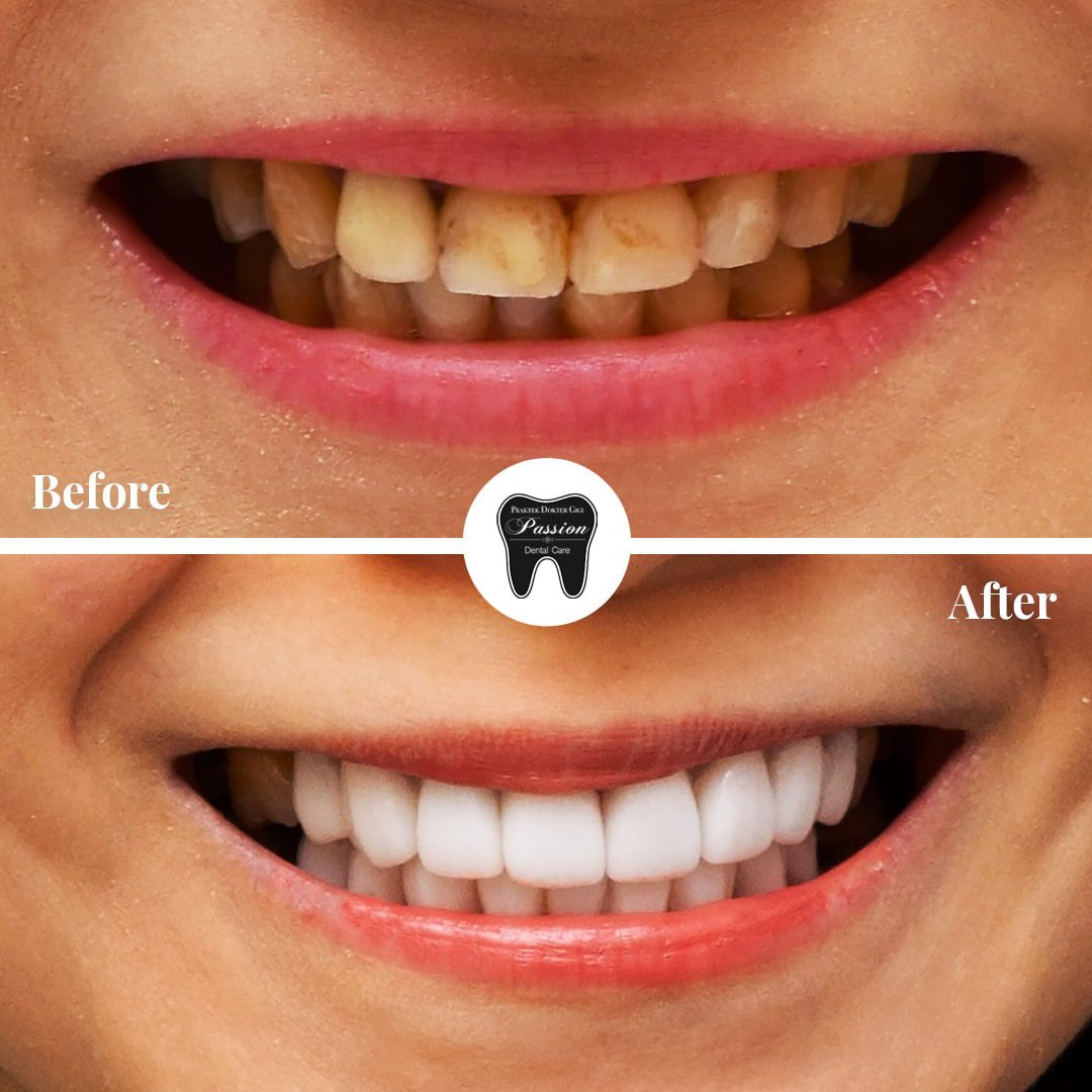 veneer-before-after-1