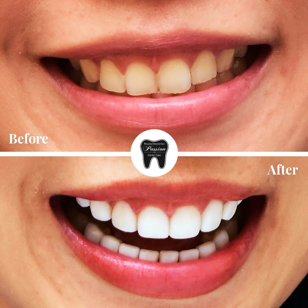 veneer-before-after-2-min