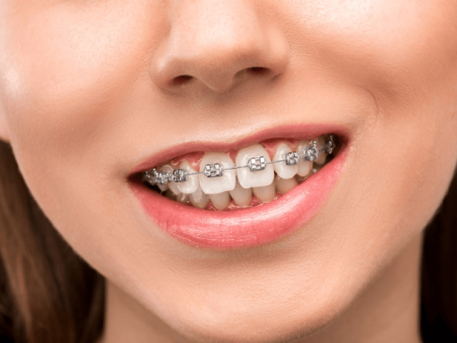Manfaat Merapikan Gigi dengan Kawat Gigi