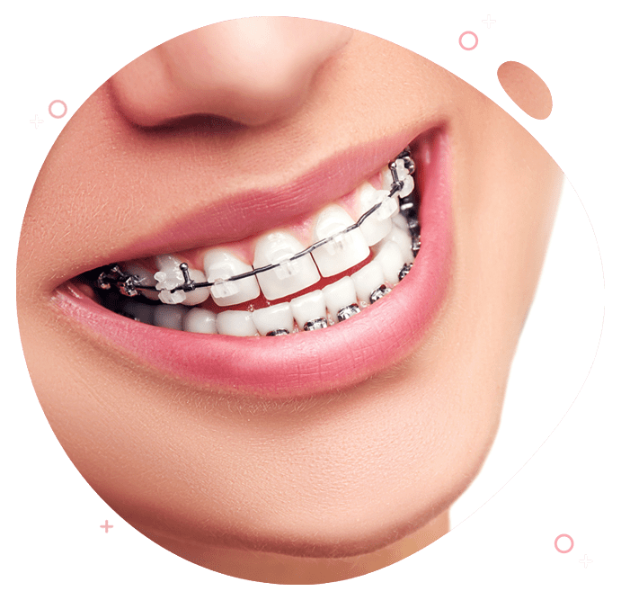 https://www.passiondentalcare.com/wp-content/uploads/2023/05/behel-images.png