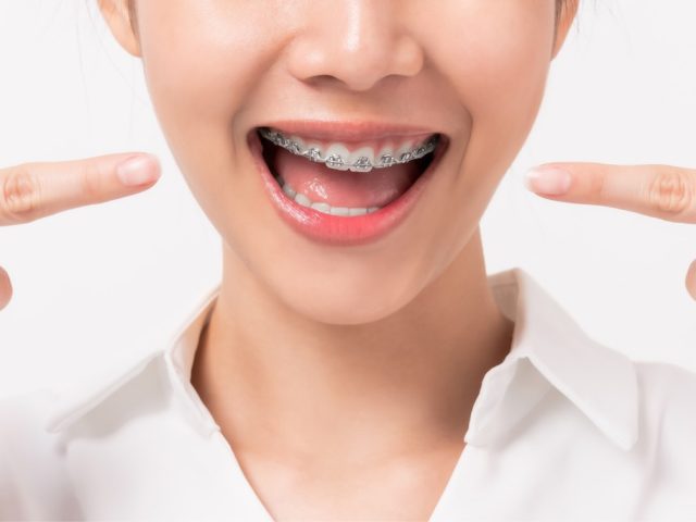 Daftar Harga Pasang Behel di Klinik Gigi Sesuai dengan Jenisnya!
