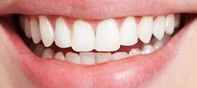 Ini Penyebab Munculnya Karang Gigi dan Cara Mengatasinya!