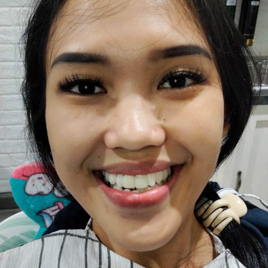 02. Ibu Dheana Gigi Patah | Passion Dental Care